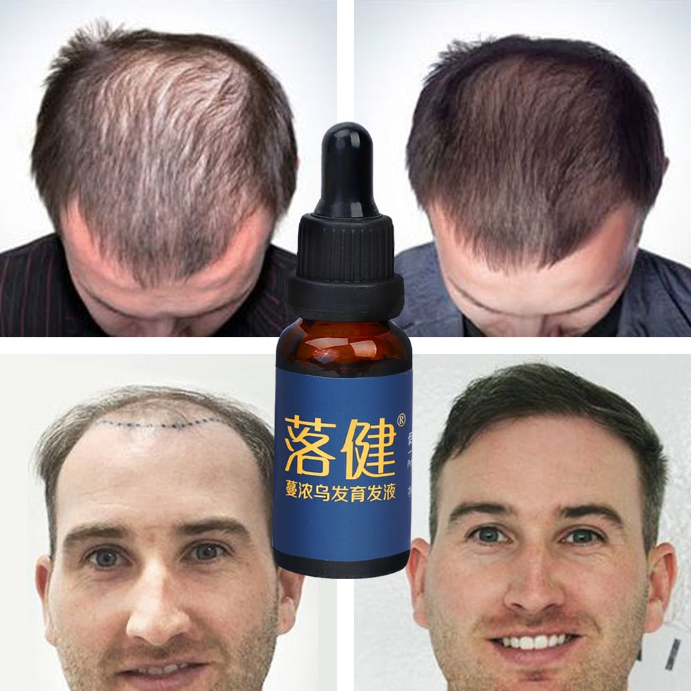 Reagain Ultimate Anti Hair Loss Treatment - HaiRegrow