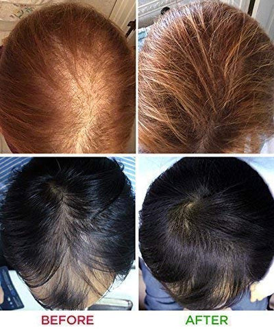 Laser Hair Growth System iRestore FDA Cleared - HaiRegrow