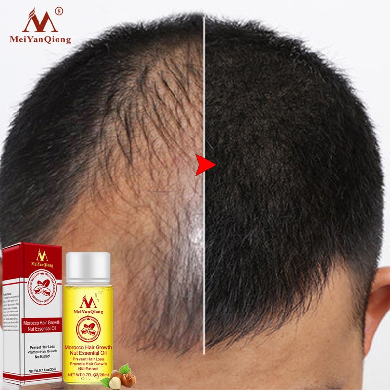 New Arrival Ginger Oil Hair Growth Serum - HaiRegrow