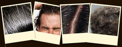 Anti Dandruff Shampoo & Anti Hair Loss BIOAQUA
