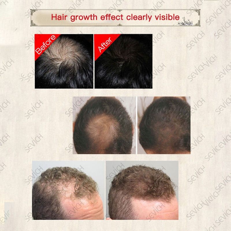 30ML Hair Regrowth Essence Intensive Spray