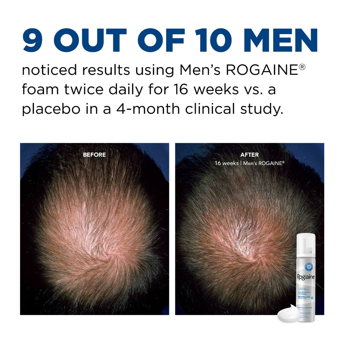 Rogaine Foam Hair Loss & Regrowth Treatment 5% Minoxidil - 1,2,3,6 Month Supply